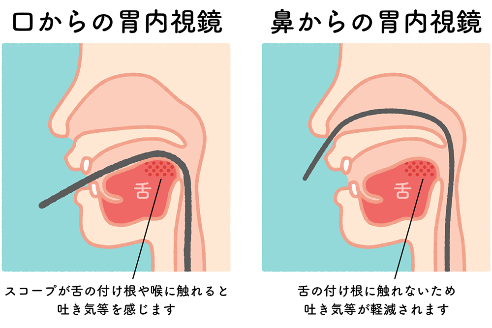 鼻からできる「経鼻内視鏡」も選択可能