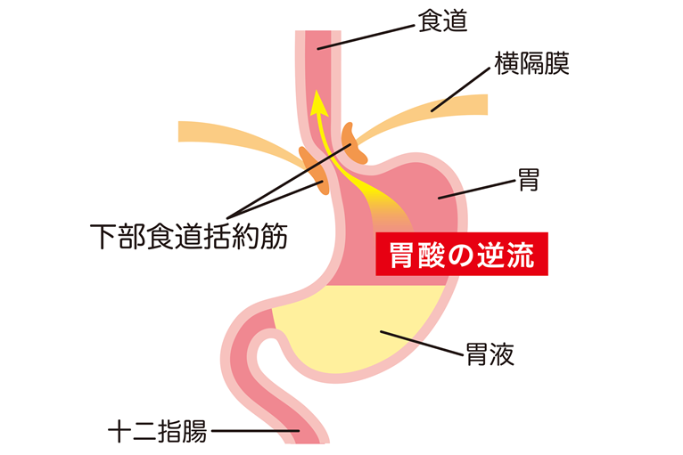 逆流性食道炎とはどんな病気？