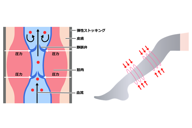 医療用弾性ストッキング